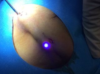 Lifting non chirurgico con il laser