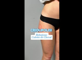 Criolipolisi - Hippokrates Centro Medico Estetico