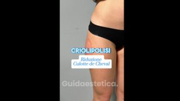 Criolipolisi - Hippokrates Centro Medico Estetico
