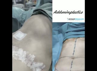 Addominoplastica - Dott. Hicham Mouallem