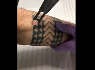 Dott.ssa Cotilli: Rimozione tatuaggio