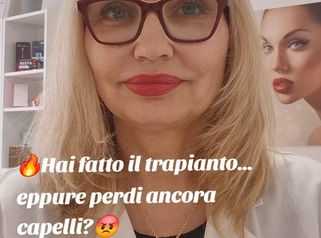 2025-04-21 Hai fatto trapianto, ma.... capelli ancora cadono