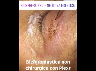 Blefaroplastica non chirurgica - Studio medico BiospheraMed