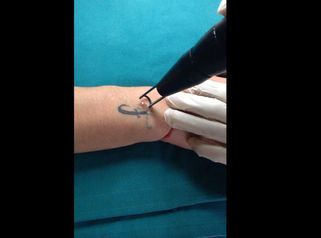 Medicina Estetica Cotilli: Rimozione tatuaggi