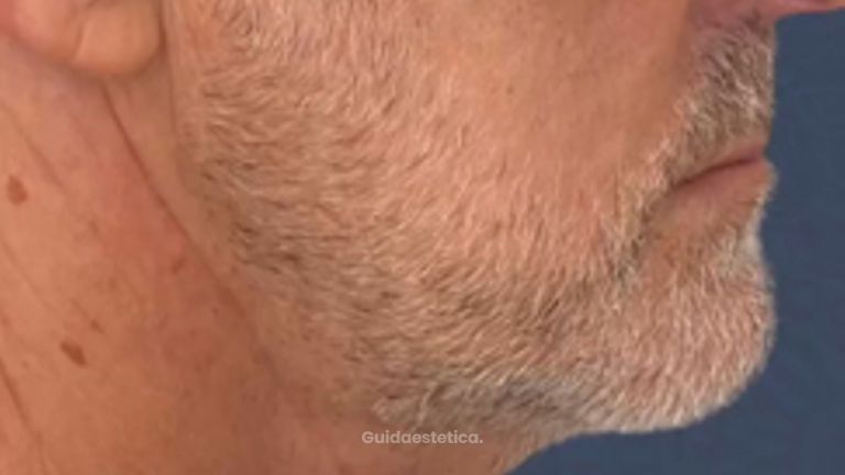 Dr Luciano Perrone Endolift