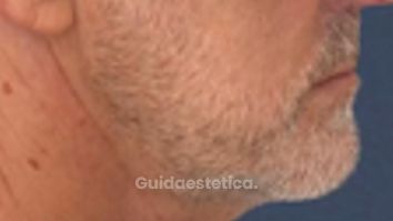 Dr Luciano Perrone Endolift