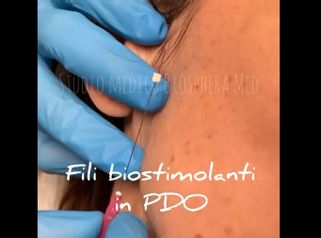 Fili riassorbibili - Studio medico BiospheraMed