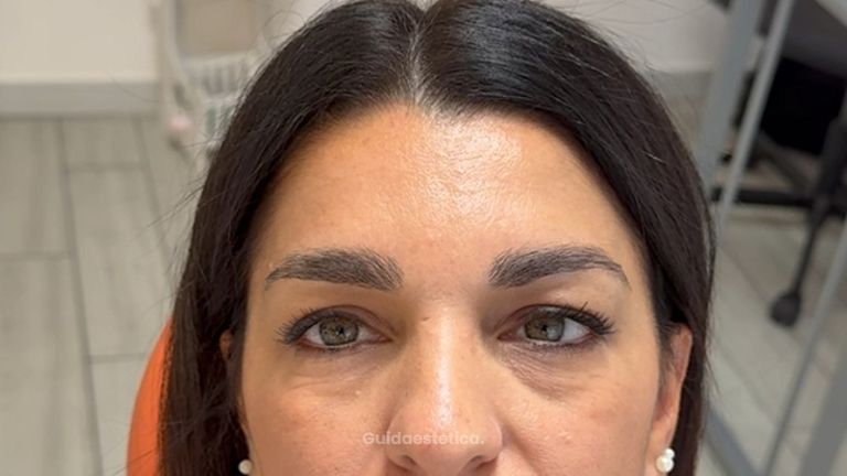 Dott.ssa Sara Carinci Risultati dopo trattamento Botox