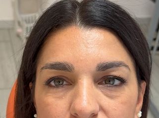 Dott.ssa Sara Carinci Risultati dopo trattamento Botox