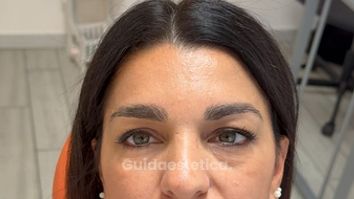 Dott.ssa Sara Carinci Risultati dopo trattamento Botox