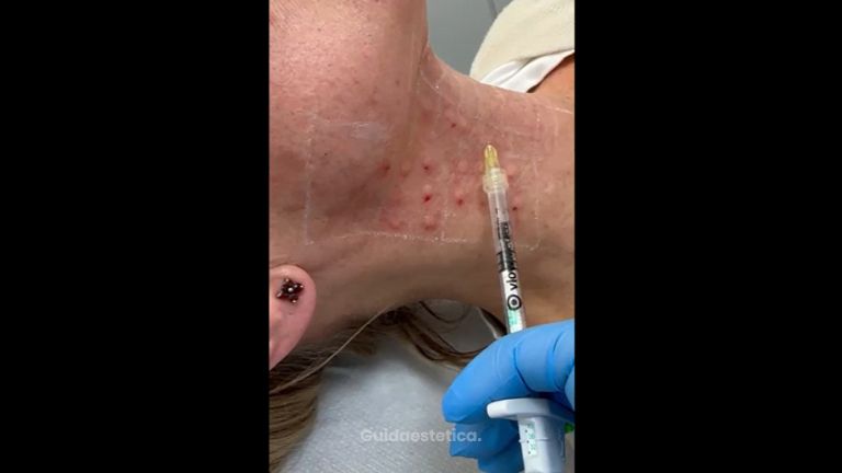 Mesoterapia - Dott.ssa Lusinda Osmanagaj