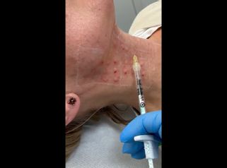 Mesoterapia - Dott.ssa Lusinda Osmanagaj