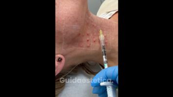 Mesoterapia - Dott.ssa Lusinda Osmanagaj