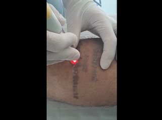 Rimozione tatuaggi - Tuamedica