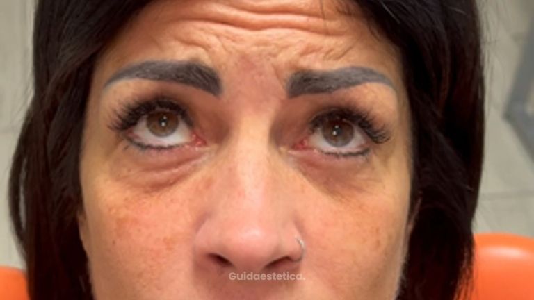 Dott.ssa Sara Carinci Botox terzo superiore