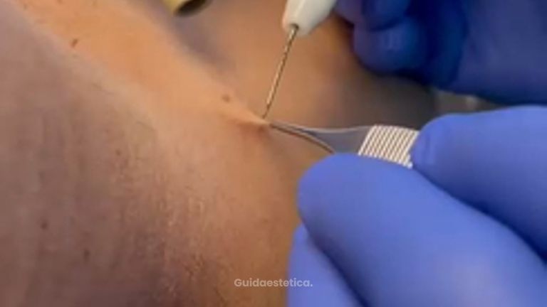 Studio Medico Brenno Franceschini Fibroma della pelle rimosso con il plasma