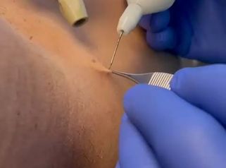 Studio Medico Brenno Franceschini Fibroma della pelle rimosso con il plasma