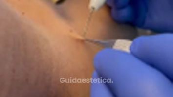 Studio Medico Brenno Franceschini Fibroma della pelle rimosso con il plasma