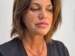 Dott.ssa Sara Carinci Risultato immediato del trattamento di filler labbra