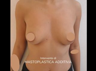Mastoplastica additiva - Cristina Napoleone Chirurgo Plastico, Med. Estetica
