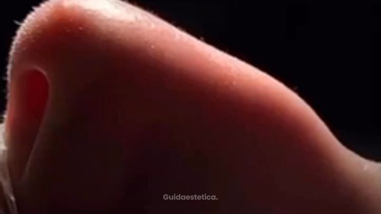 Rinosettoplastica