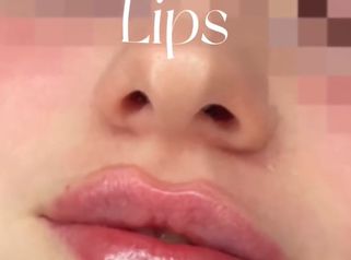 Russian lips - Studio Medico Adigrat