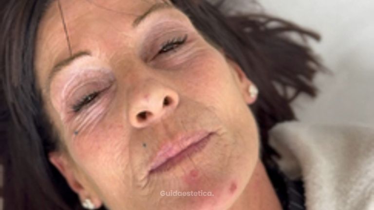 Dott.ssa Sara Carinci Filler labbra: risultato dopo il trattamento su paziente reale