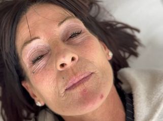 Dott.ssa Sara Carinci Filler labbra: risultato dopo il trattamento su paziente reale