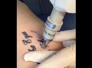 HS Care: Rimozione tatuaggio