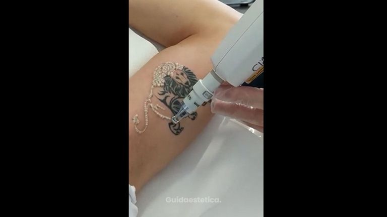 Rimozione tatuaggi - Lasermed Srl