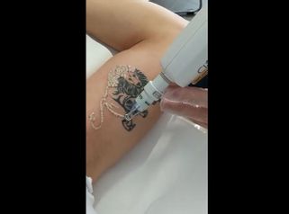Rimozione tatuaggi - Lasermed Srl