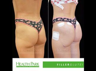 Filler glutei - Health Park- Andrea Grimaldi Medical Care