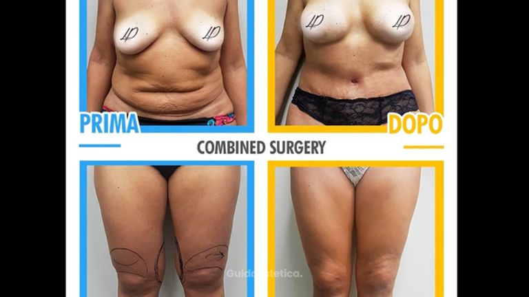 Combined surgery