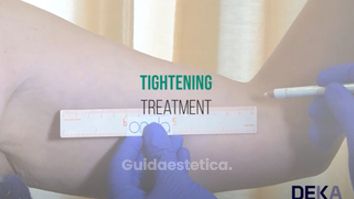 DEKA Tutorial ONDA Trattamento Tightening