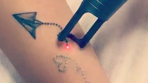 Rimozione tattoo con laser