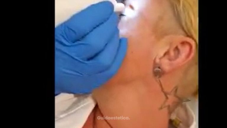 Medestetclinic: Blefaroplastica