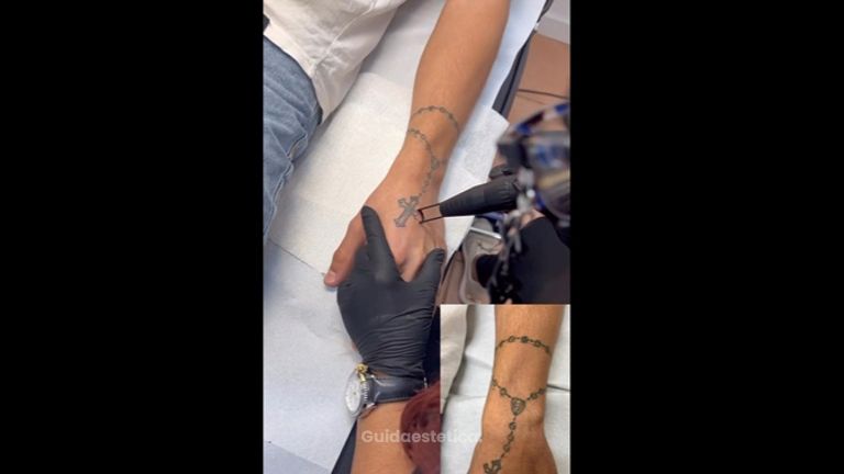 Rimozione tatuaggi - Dott.ssa Elvira Gisella Cotilli