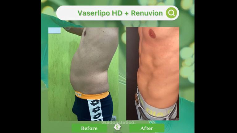 Liposuzione - Dott. Umberto Tozzi - Clinique Visage
