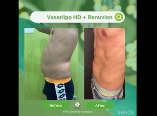 Liposuzione - Dott. Umberto Tozzi - Clinique Visage