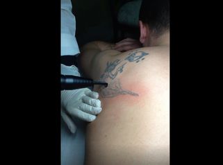 Medicina Estetica Cotilli: Intervento di  rimozione dei tatuaggi