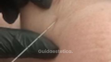 Dott.ssa Cornelia Florea Trattamento viso con acido ialuronico mediante cannula