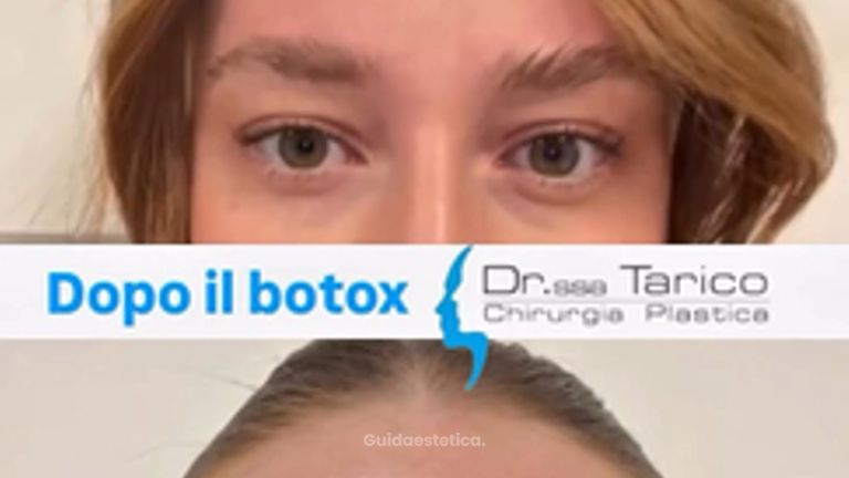 Dott.ssa Maria Stella Tarico Botulino: effetti dopo una settimana su sguardo e rughe