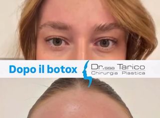 Dott.ssa Maria Stella Tarico Botulino: effetti dopo una settimana su sguardo e rughe