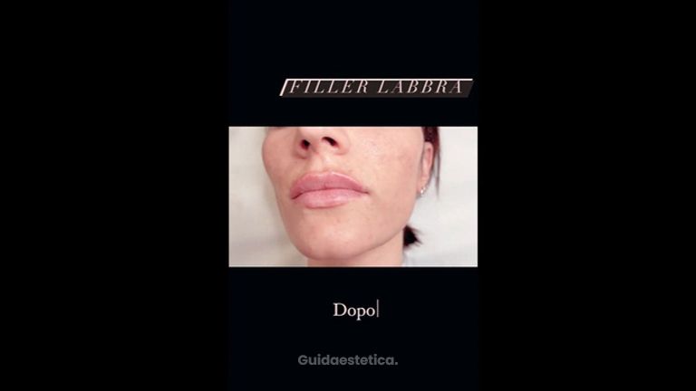 Filler labbra - Dott.ssa Paola Nardolillo