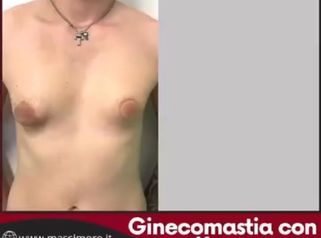 Dott. Massimo Re Ginecomastia