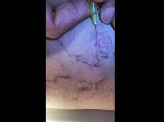 Dott. Giuffrida: Vene varicose