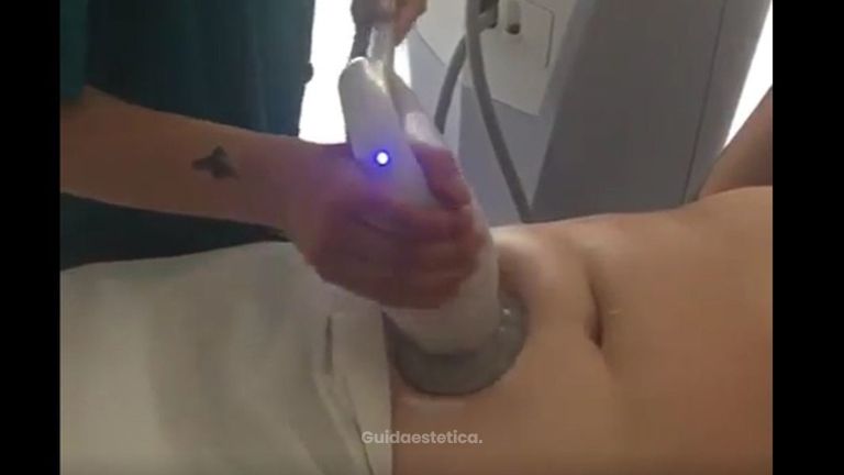 Cavitazion-Ultrasuono per adiposità localizzate Total Body
