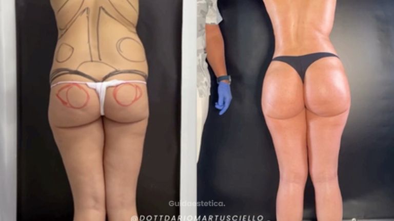 Dott. Dario Martusciello Lipoplastica Robotica