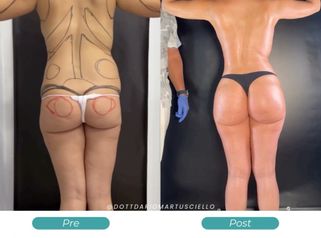 Dott. Dario Martusciello Lipoplastica Robotica