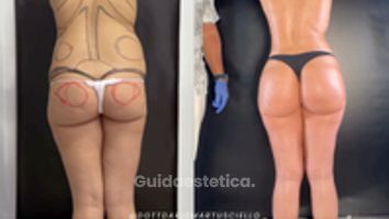 Dott. Dario Martusciello Lipoplastica Robotica